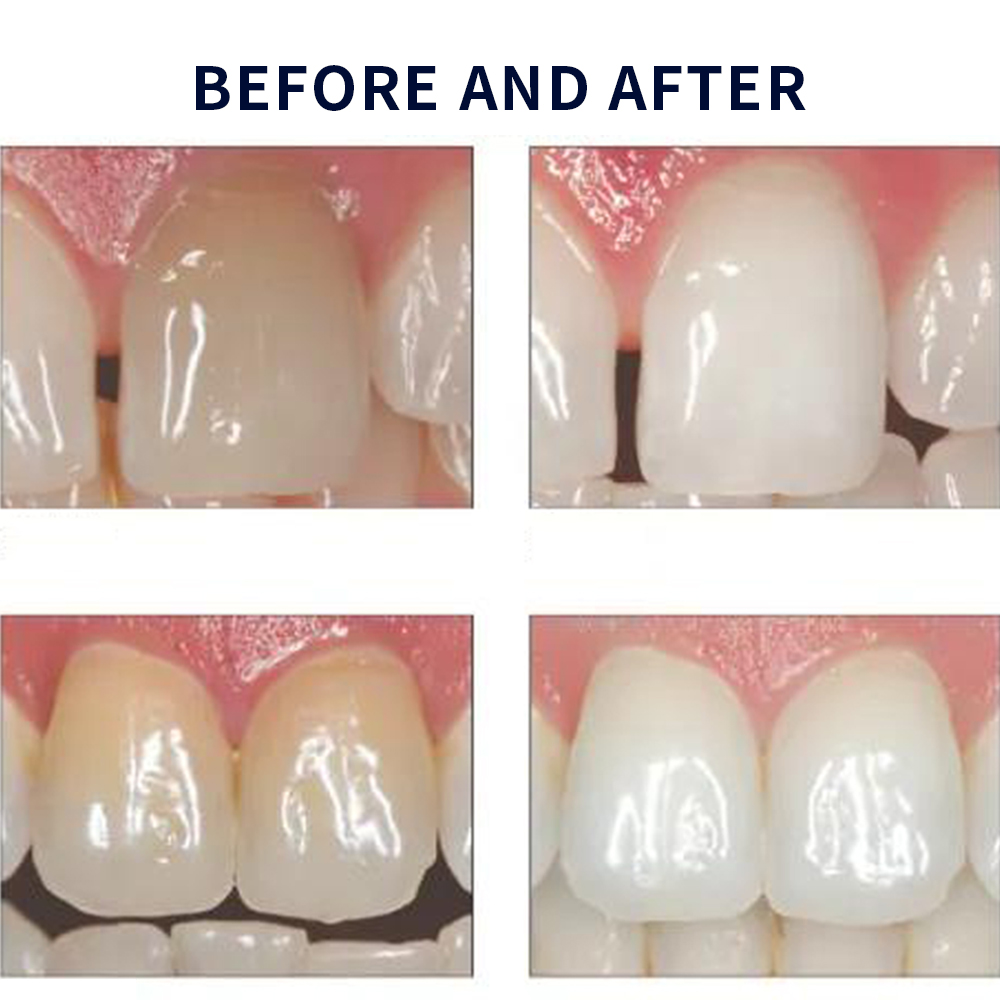 Opalescence Whitening 20% PF 2 – Teeth Whitening With Hydrogen Peroxide Bewertung und Preis