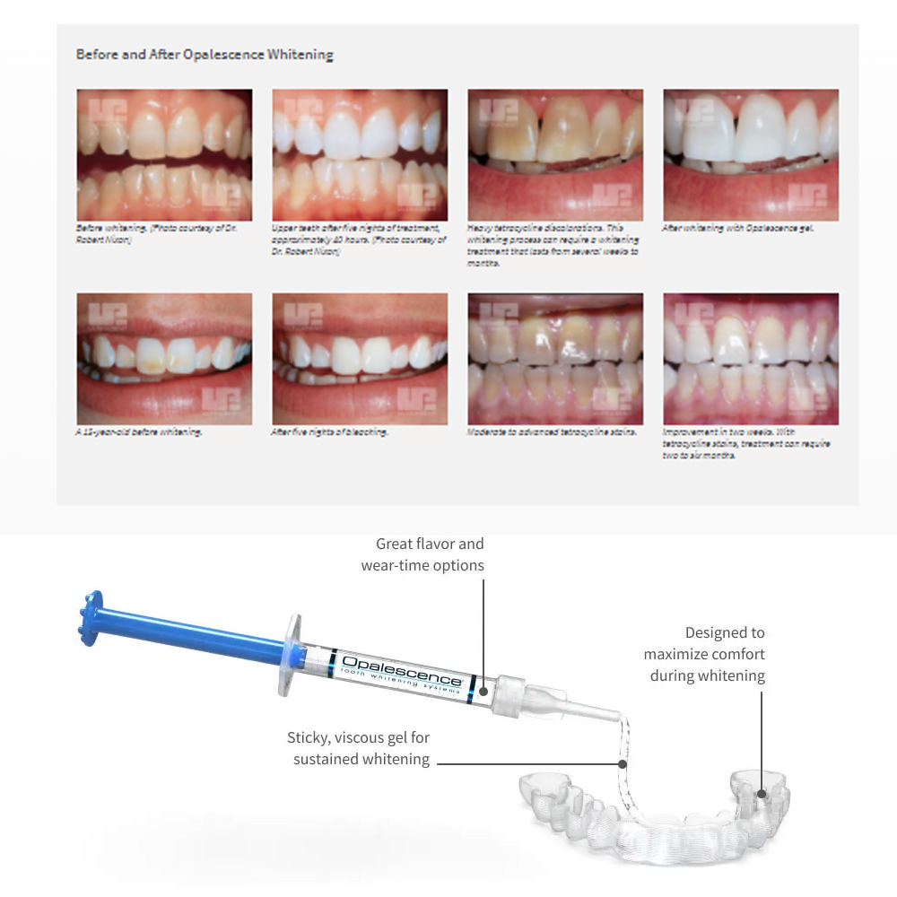 Opalescence Whitening 20% PF 2 – Teeth Whitening With Hydrogen Peroxide Bewertung und Preis