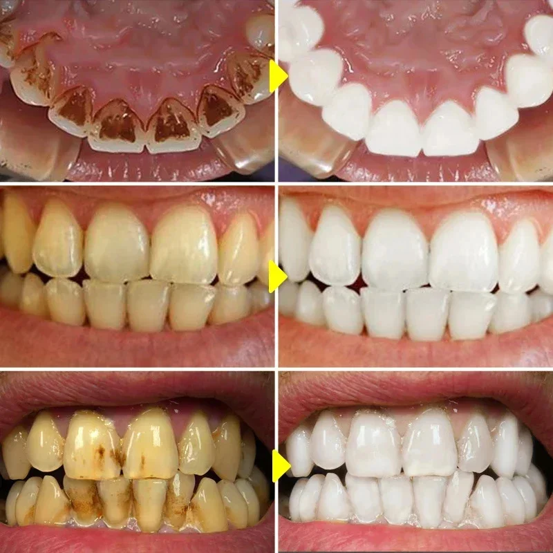 Teeth Whitening Toothpaste Fru – Teeth Whitening Xylitol Bewertung und Preis