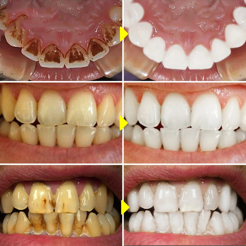 V34 Teeth Whitening Mousse Too – Teeth Whitening Xylitol Bewertung und Preis