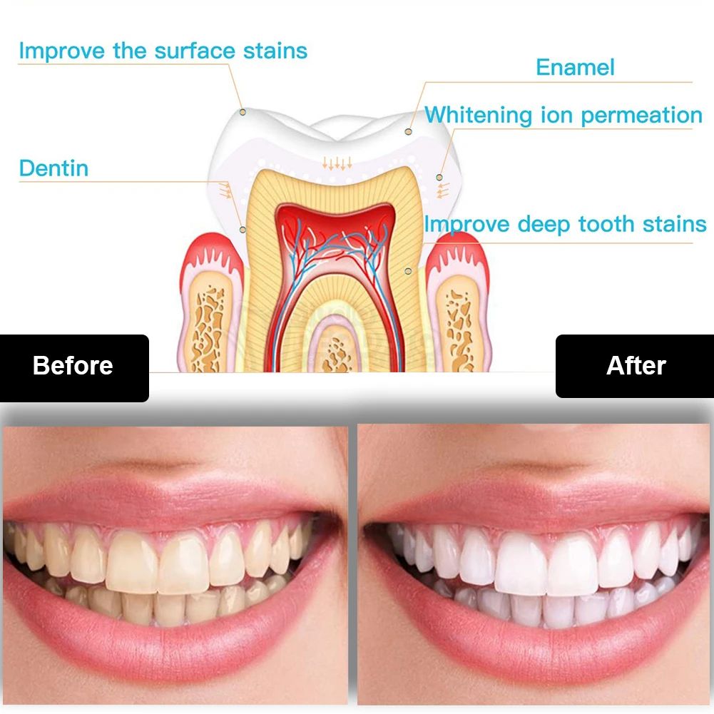 Dental Teeth Whitening Kit Min – Teeth Whitening Price Bewertung und Preis